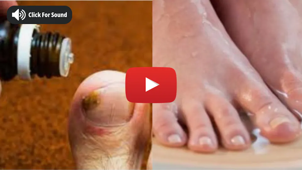 Toenail Fungus Breakthrough