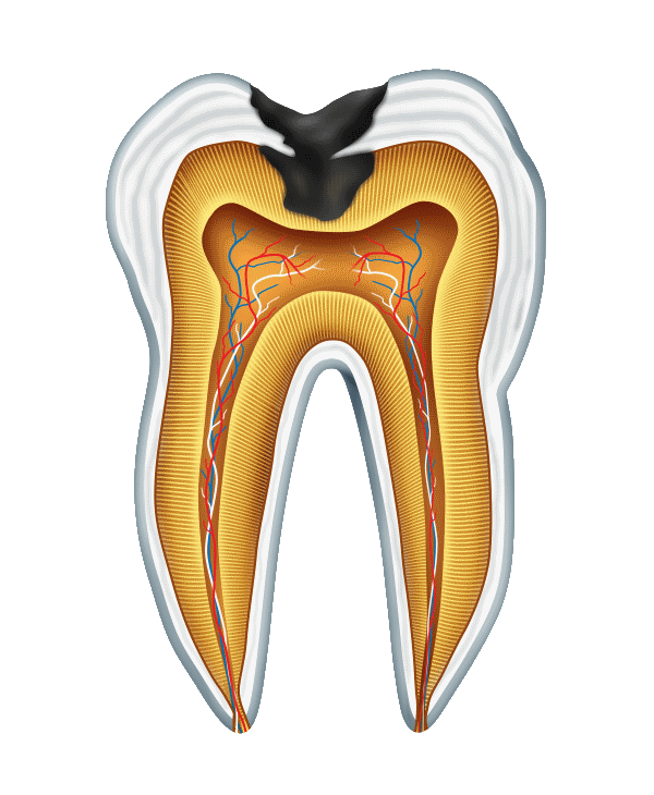 Root Canal Near Lake Elsinore, CA. Low root canal cost treatment by