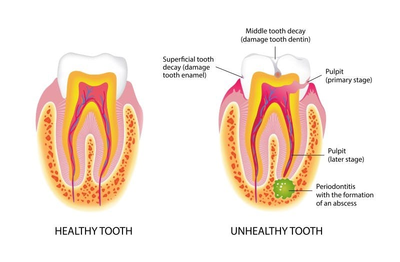 Root canals | La Habra, CA | Orange County, California | Summit Smiles