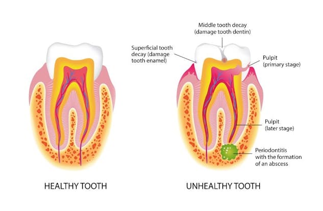 Root Canal Near Newport Beach, Orange County, CA. Low root canal cost ...