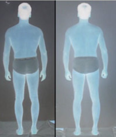 Before and after Rolfing