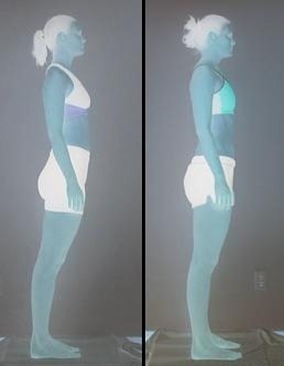 Before and after Rolfing