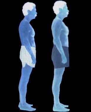Before and after Rolfing — first client, 1991